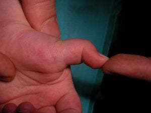 Çocuk Tetik Başparmağı